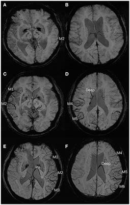 Cortical Venous Changes on Susceptibility-Weighted Imaging Predict the Cerebral Collateral Circulation as Confirmed by Digital Subtraction Angiography